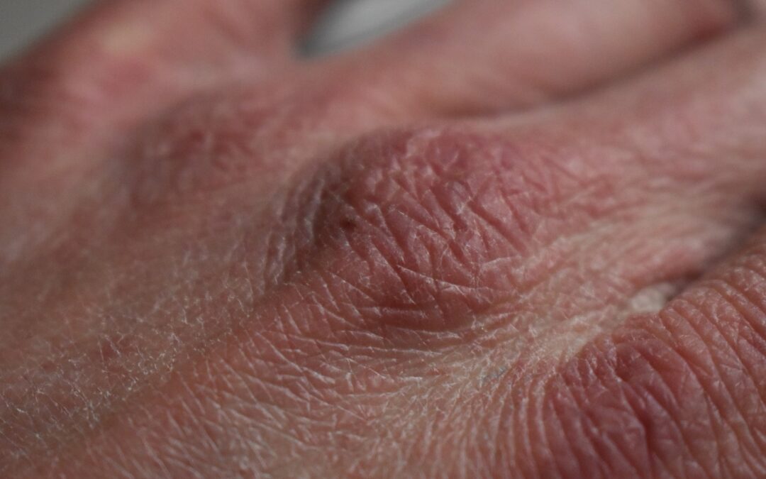 Does Soft Water Help Dry Skin?